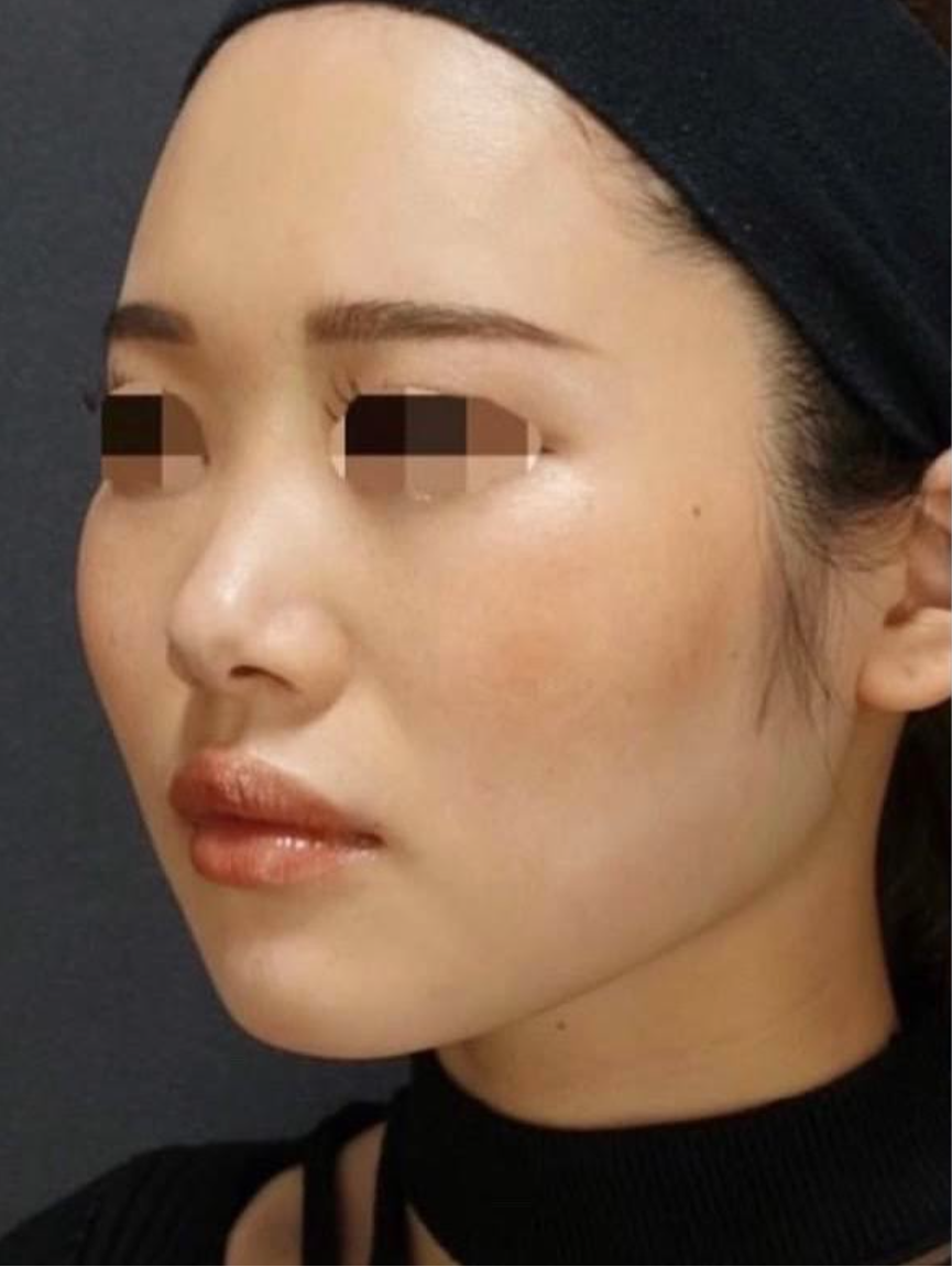 Nose Filler Before & After Patient #595