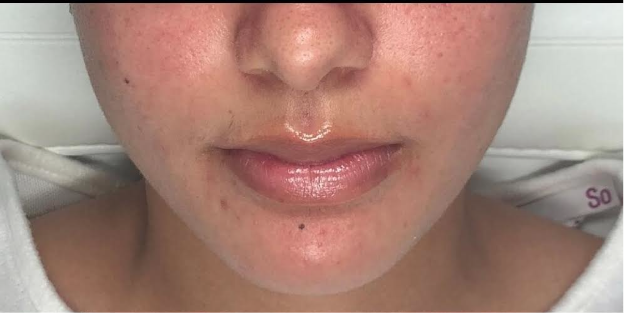 Facial Before & After Patient #596
