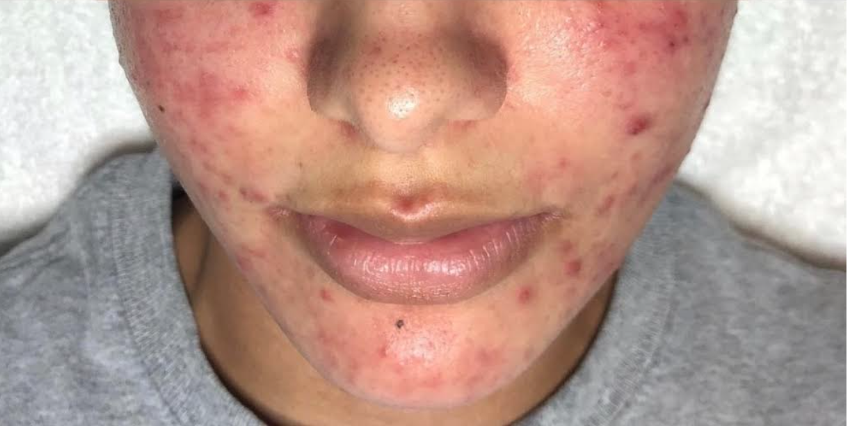 Facial Before & After Patient #596
