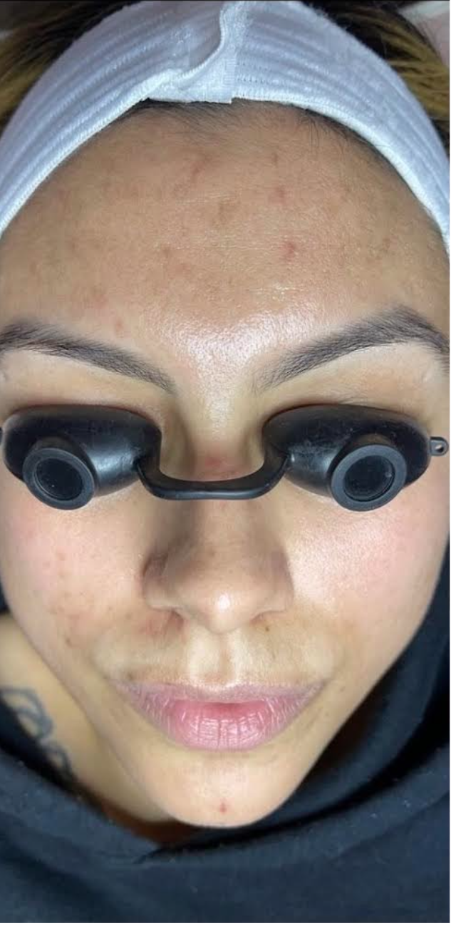 Facial Before & After Patient #597