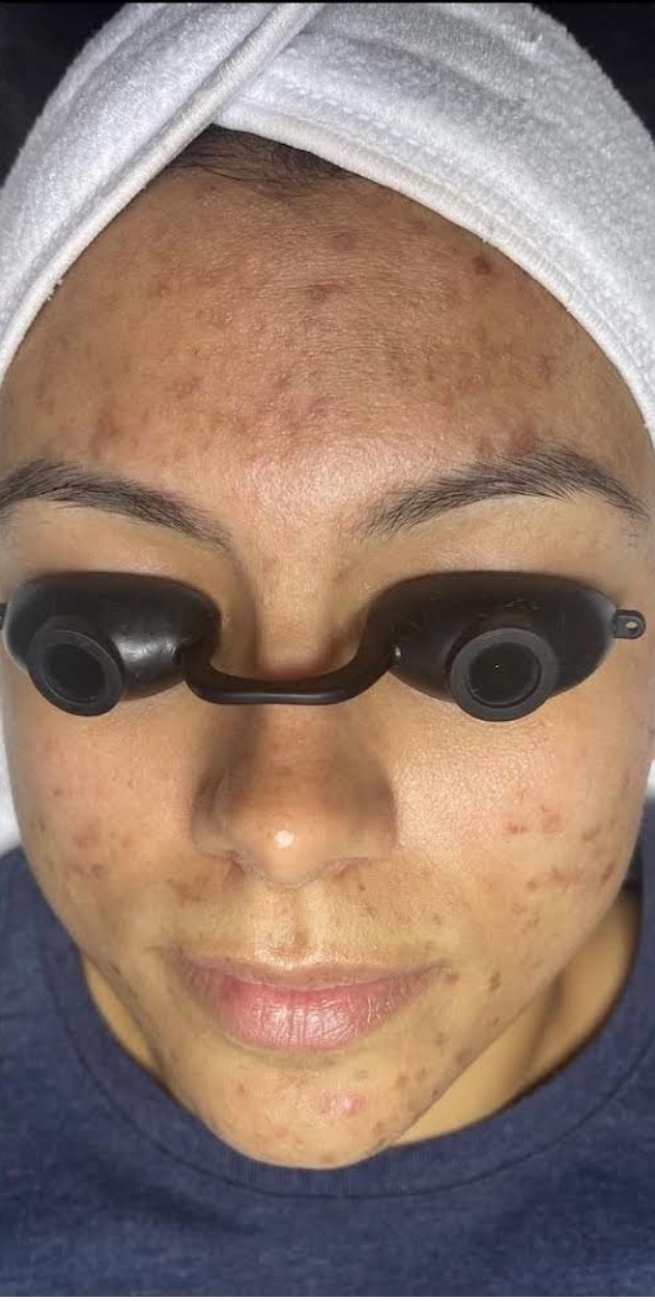 Facial Before & After Patient #597