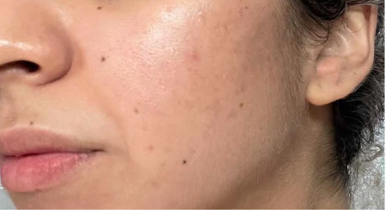 Facial Before & After Patient #598