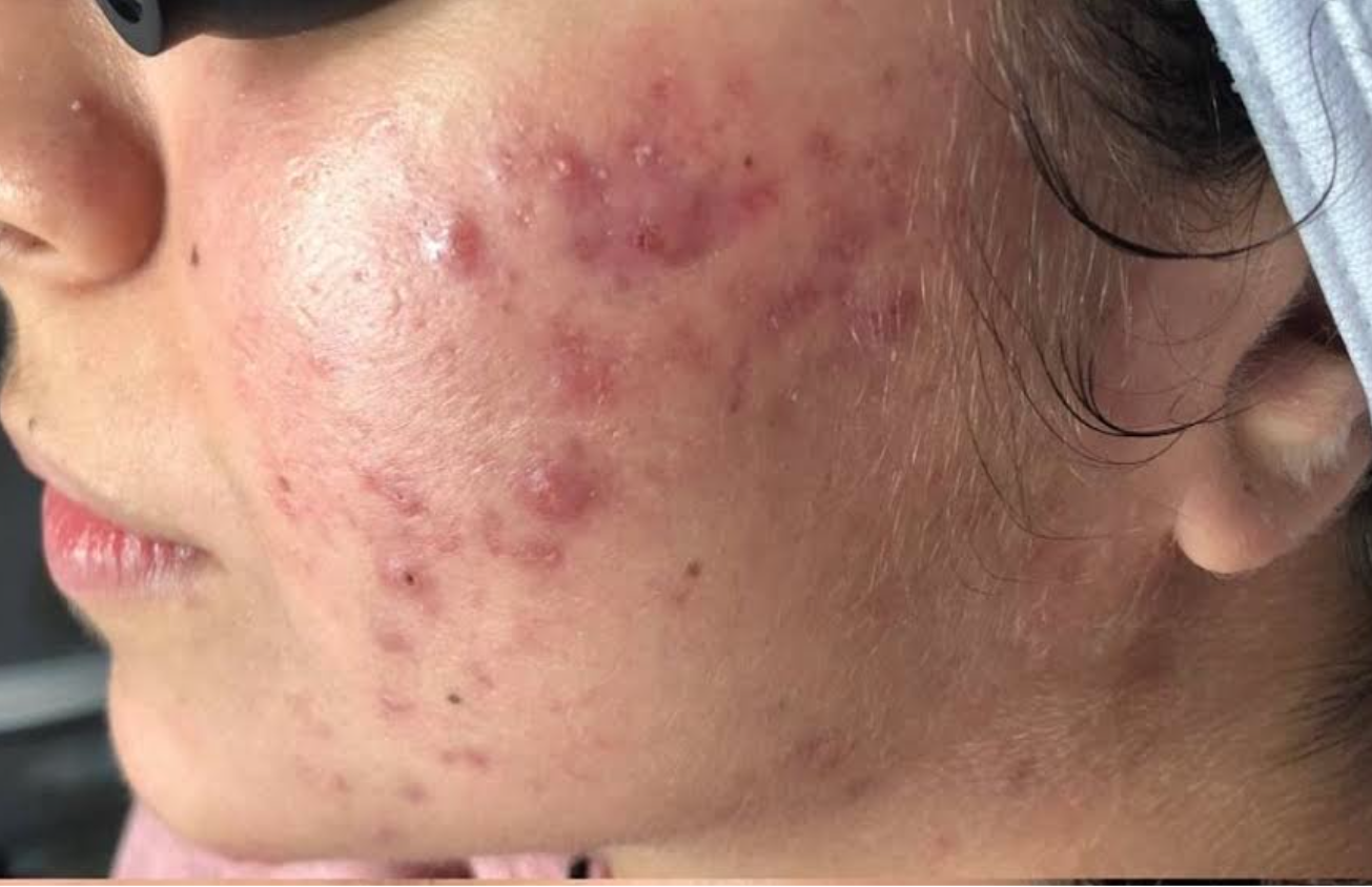 Facial Before & After Patient #598