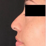 Nose Filler Before & After Patient #599