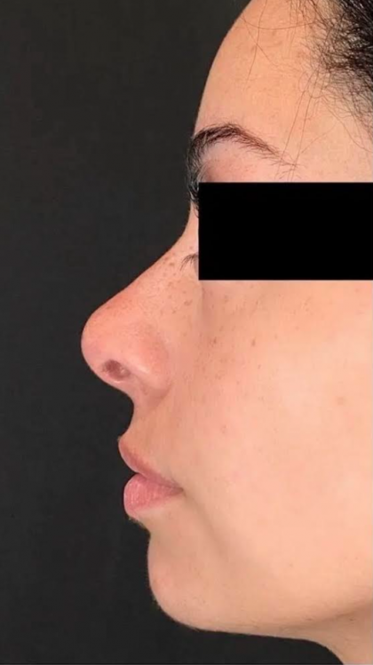 Nose Filler Before & After Patient #599