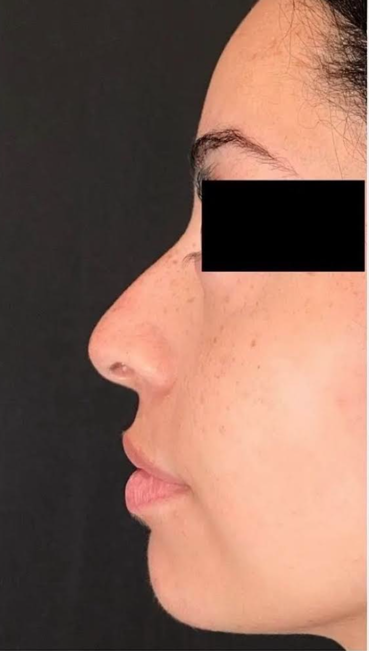 Nose Filler Before & After Patient #599