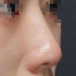 Nose Filler Before & After Patient #600