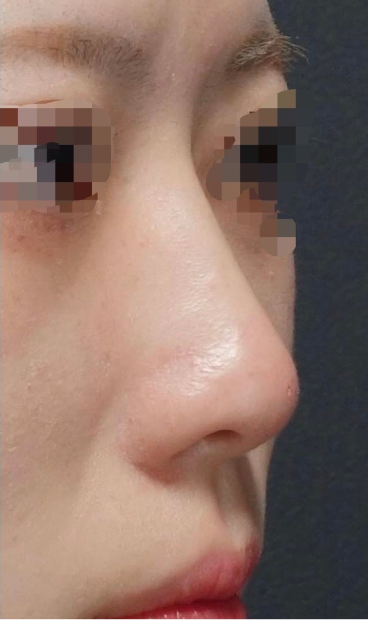 Nose Filler Before & After Patient #600