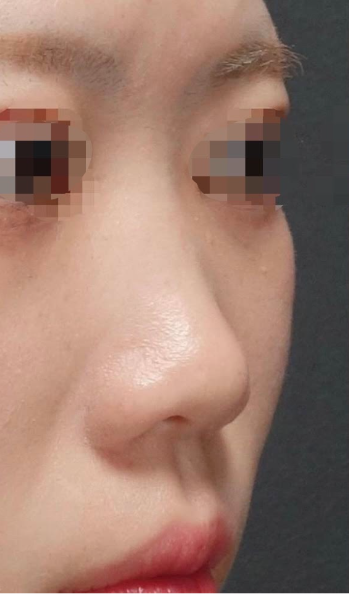 Nose Filler Before & After Patient #600