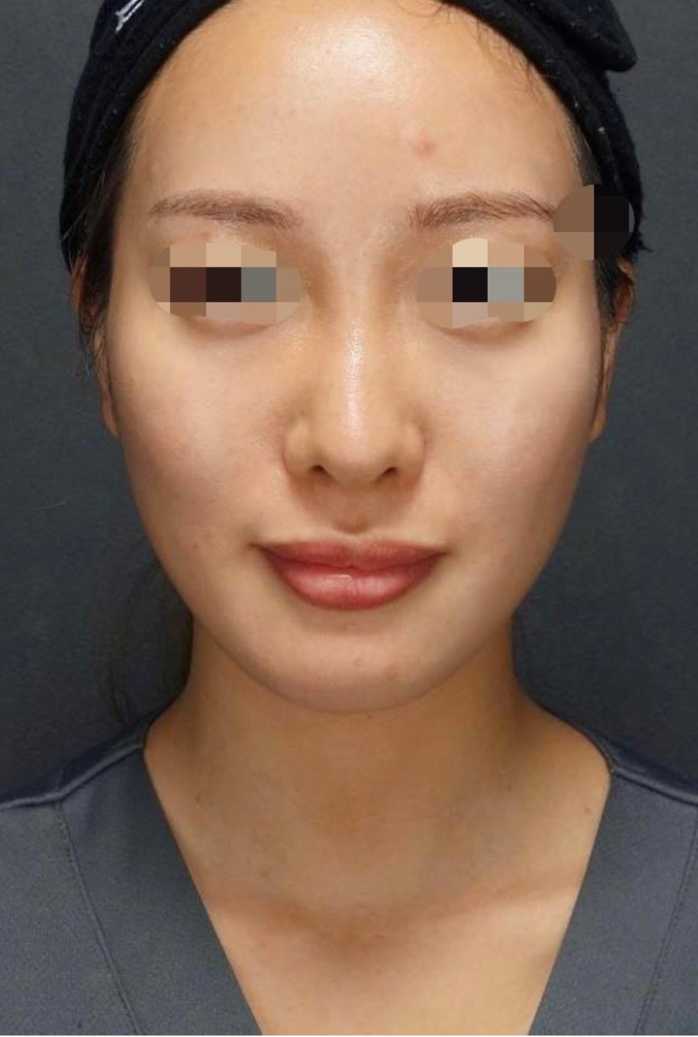 Jaw Slimming Before & After Patient #602
