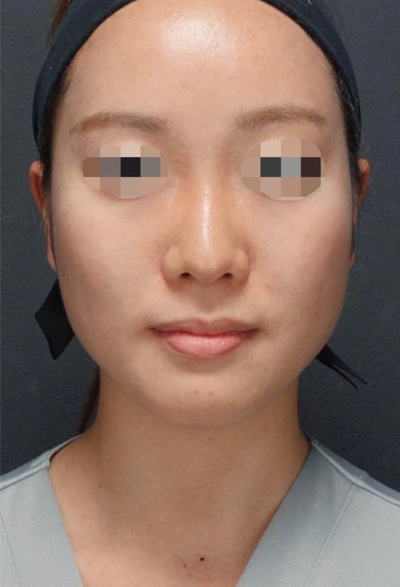 Jaw Slimming Before & After Patient #602