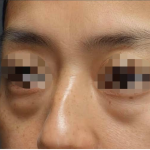 Under Eye Filler Before & After Patient #603