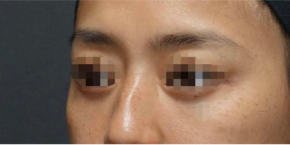 Under Eye Filler Before & After Patient #603