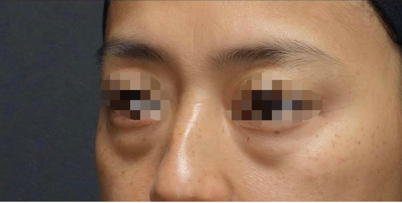 Under Eye Filler Before & After Patient #603