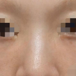 Under Eye Filler Before & After Patient #604