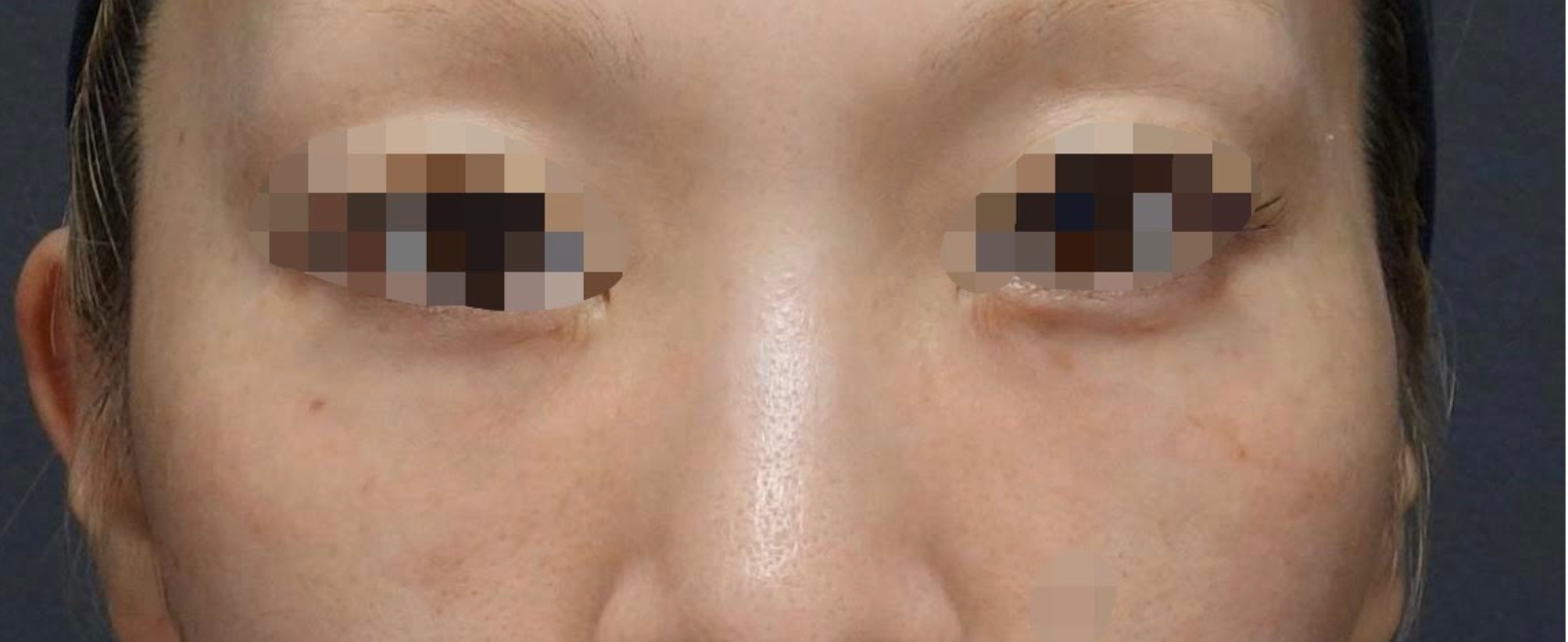 Under Eye Filler Before & After Patient #604