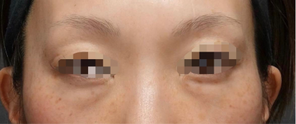 Under Eye Filler Before & After Patient #604