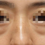 Under Eye Filler Before & After Patient #605