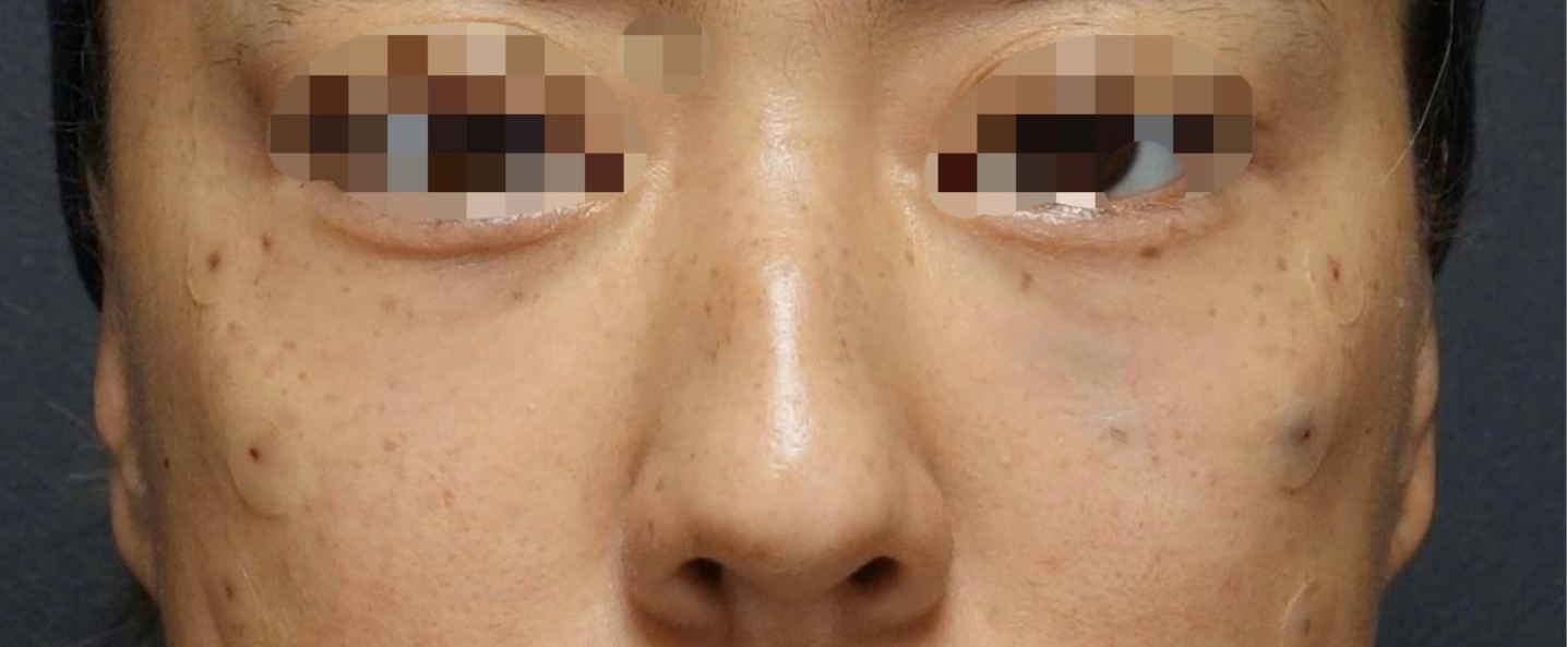 Under Eye Filler Before & After Patient #605