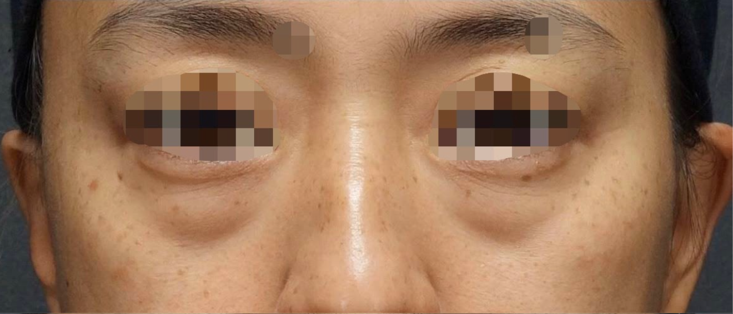 Under Eye Filler Before & After Patient #605