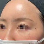 Forehead Filler Before & After Patient #606