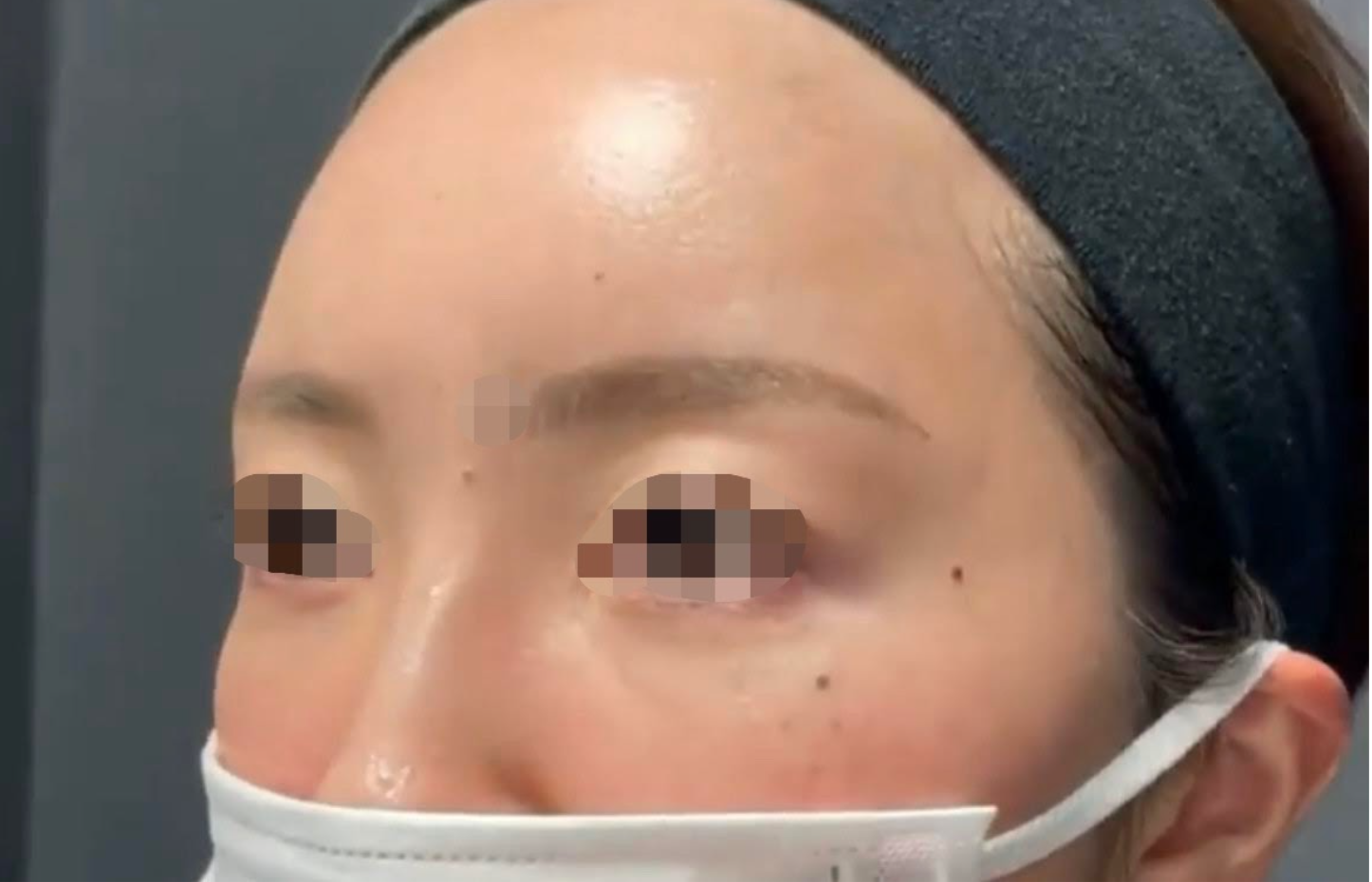 Forehead Filler Before & After Patient #606