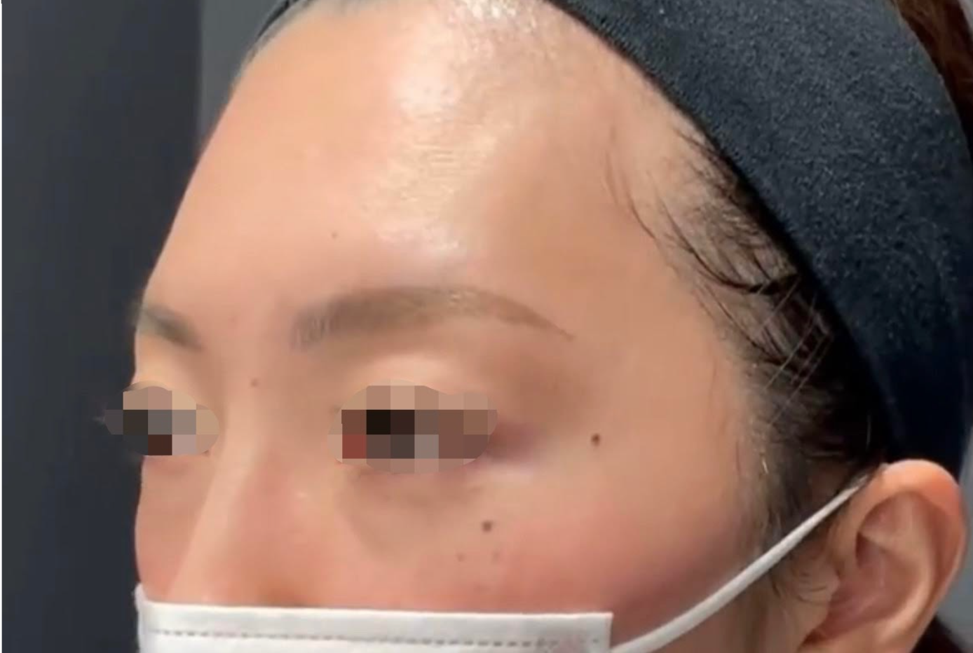 Forehead Filler Before & After Patient #606