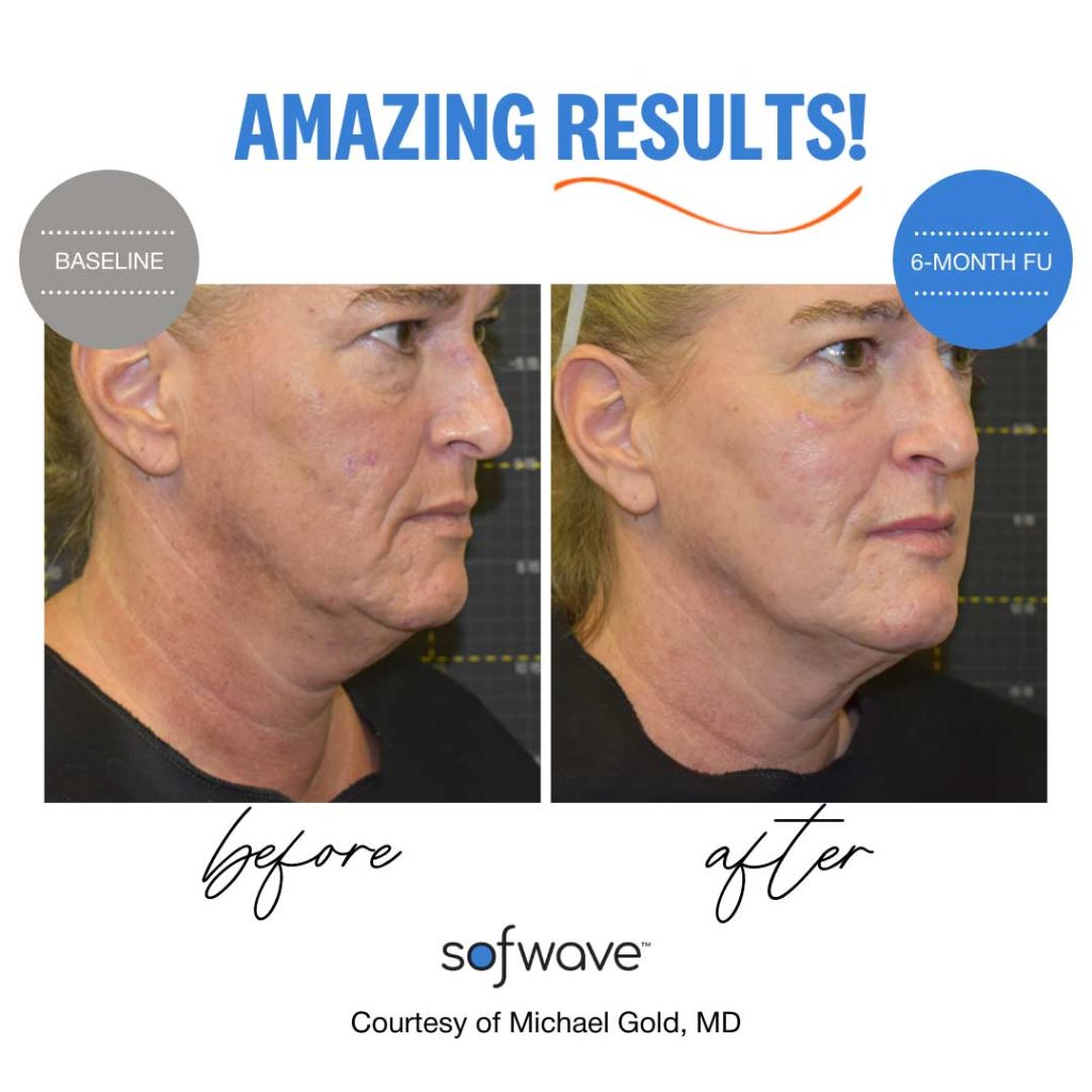 Sofwave amazing results before and after.  17 Medspa. 