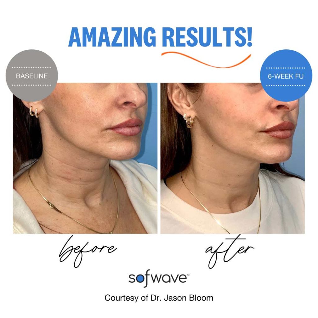Sofwave amazing results before and after.  17 Medspa. 