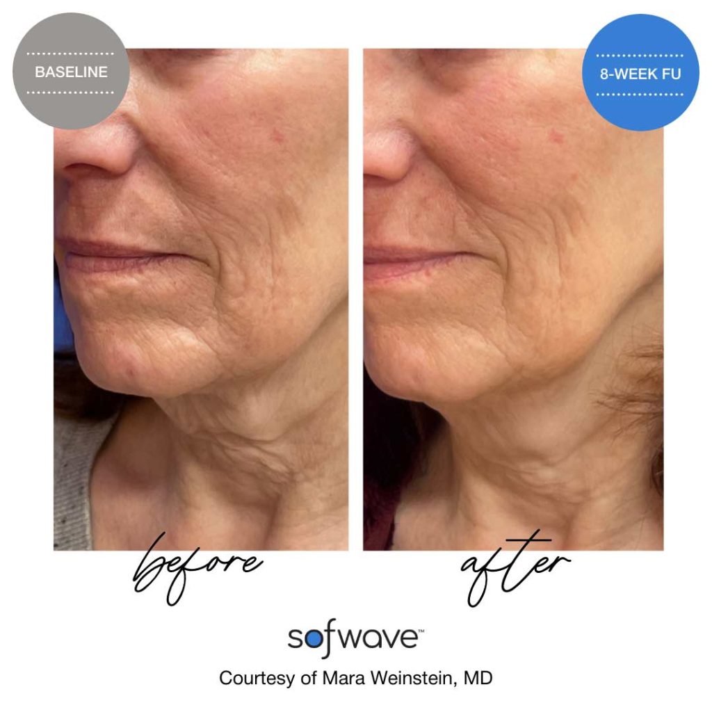 Sofwave amazing results before and after.  17 Medspa. 