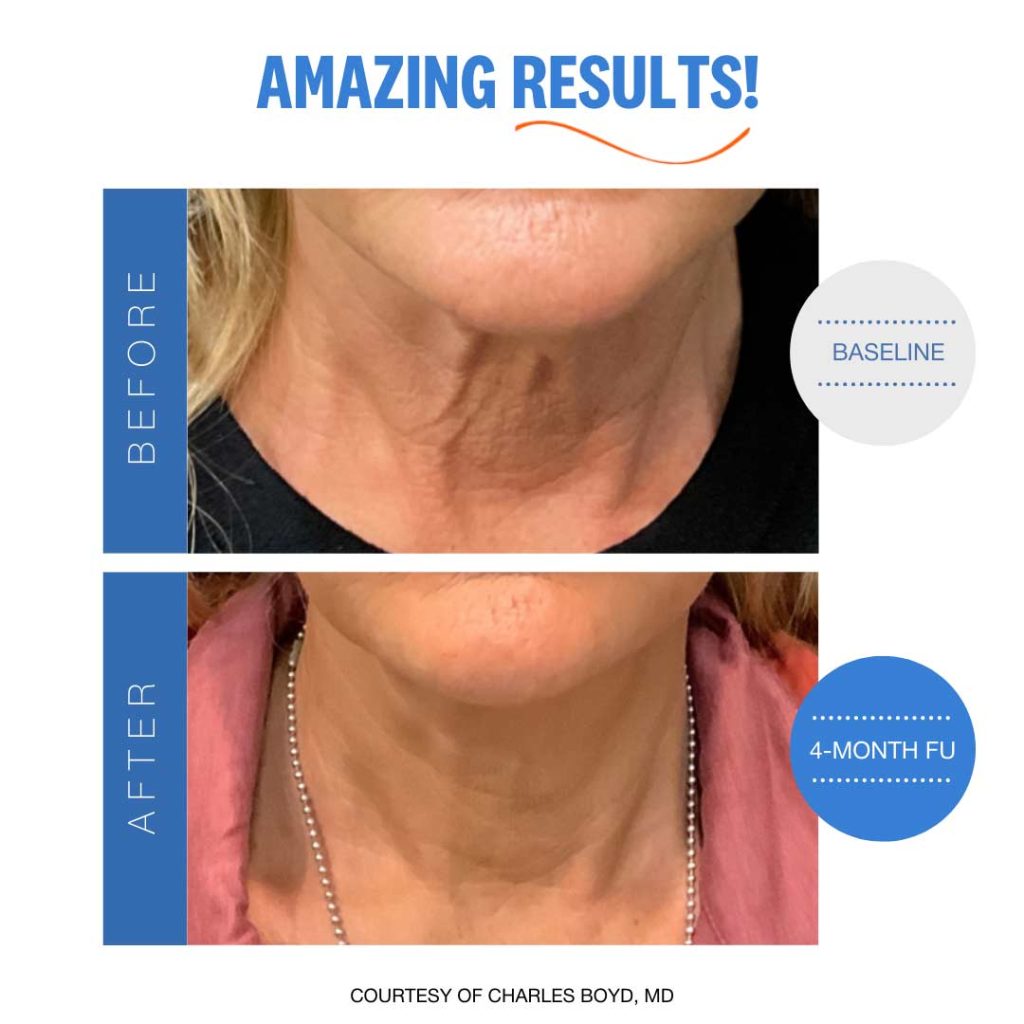 Sofwave amazing results before and after.  17 Medspa. 