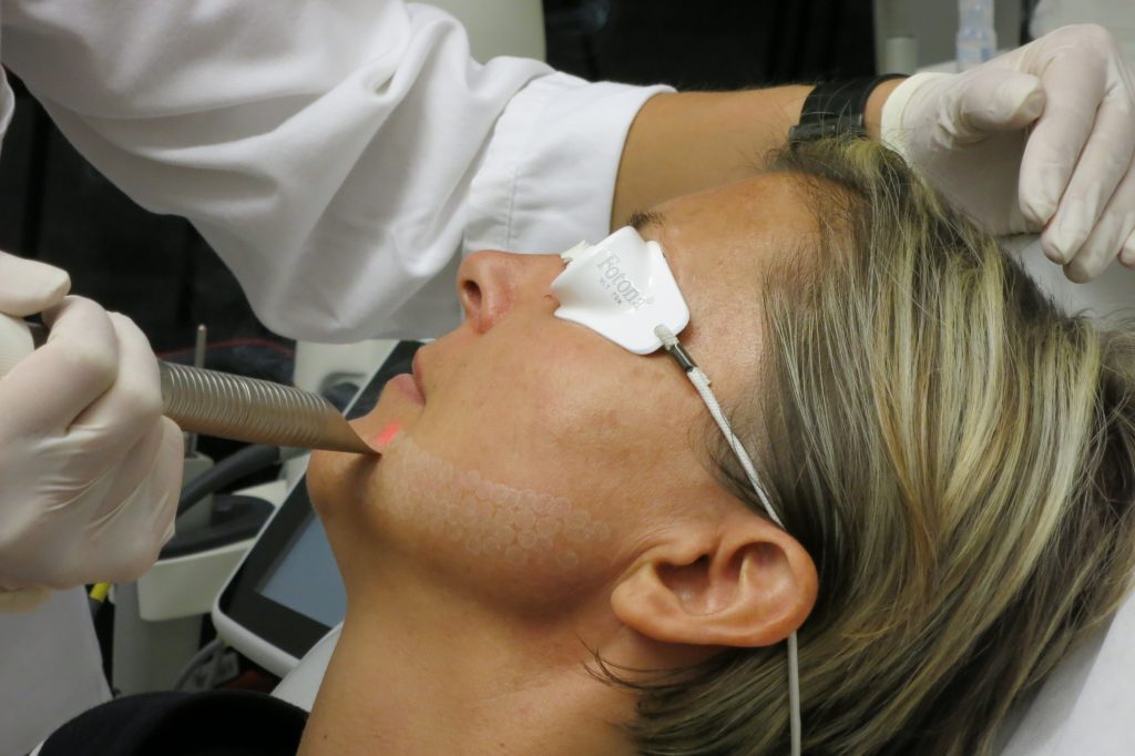 Laser Peel Buena Park