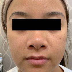 Acne Laser Before & After Patient #1112