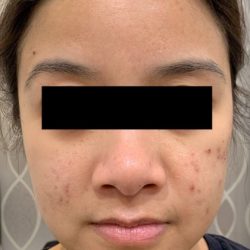 Acne Laser Before & After Patient #1112
