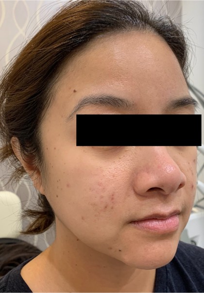 Acne Laser Before & After Patient #1112
