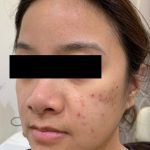 Acne Laser Before & After Patient #1112
