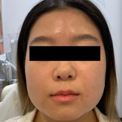 Face Tightening Before & After Patient #1122