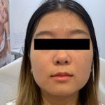 Face Tightening Before & After Patient #1122