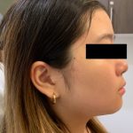 Face Tightening Before & After Patient #1122