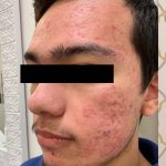 Acne Laser Before & After Patient #1244
