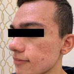 Acne Laser Before & After Patient #1244