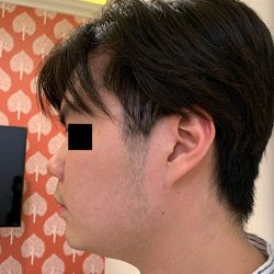 Thread Lift Before & After Patient #1245