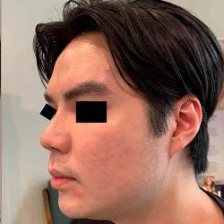 Thread Lift Before & After Patient #1245