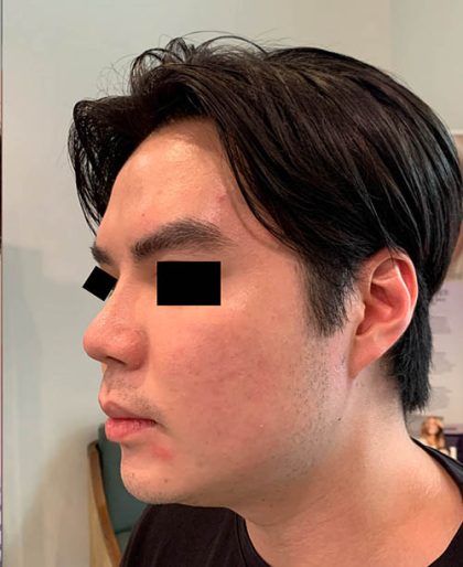 Thread Lift Before & After Patient #1245