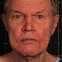 Sofwave Before & After Patient #1599