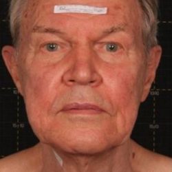 Sofwave Before & After Patient #1599