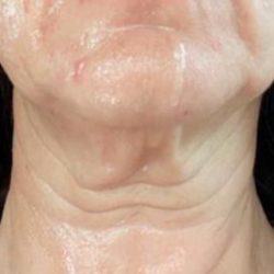 Sofwave Before & After Patient #1608