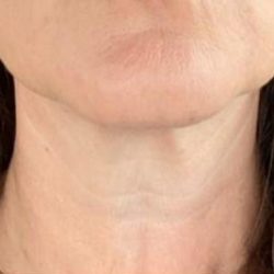 Sofwave Before & After Patient #1608