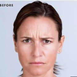 Xeomin® Before & After Patient #1581