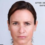 Xeomin Before & After Patient #1581